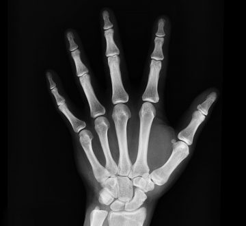 X ray of hand