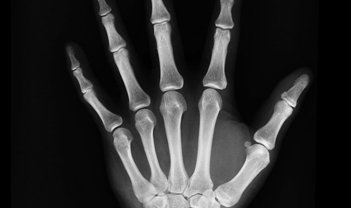 X ray of hand